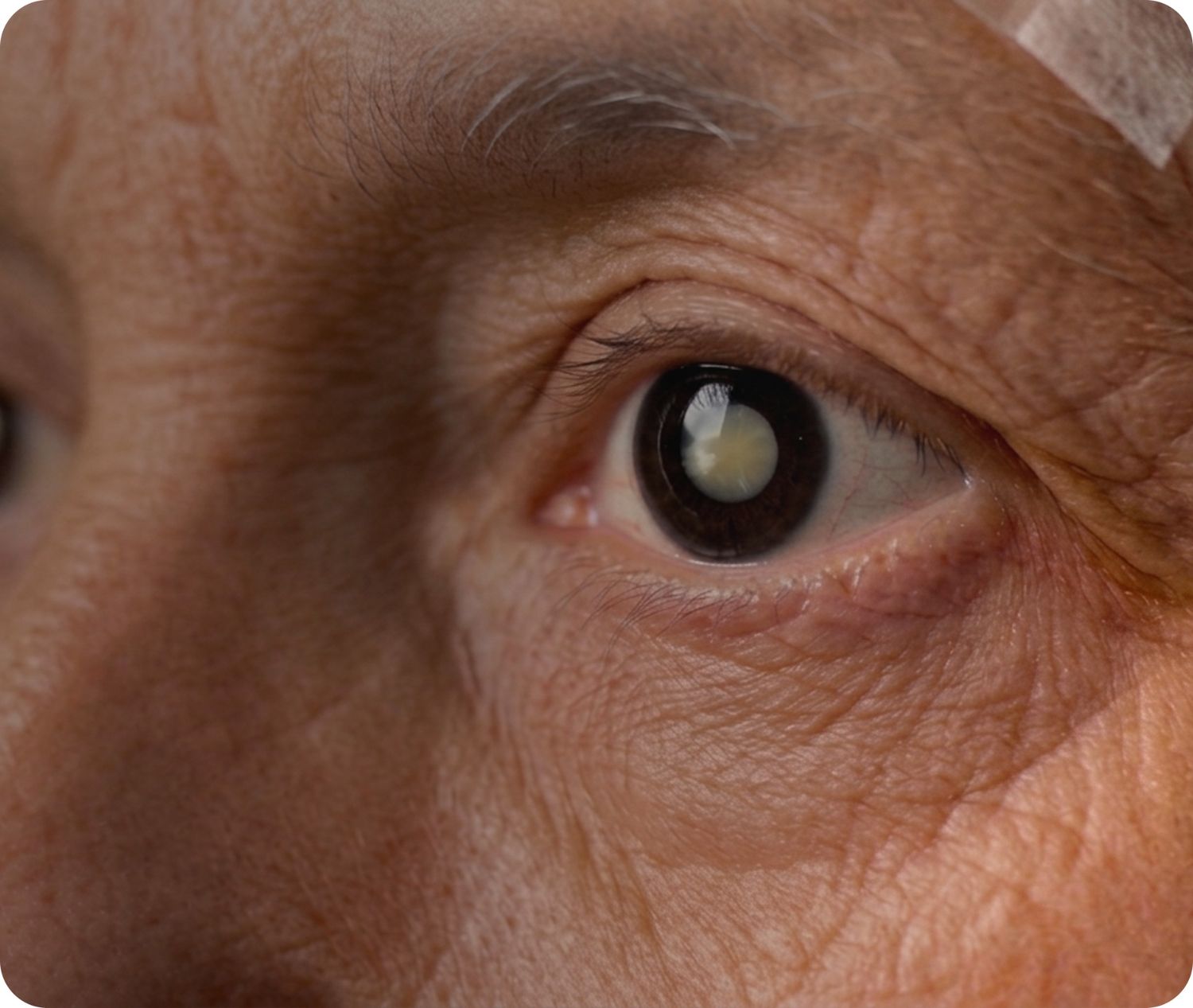 What is a Cataract?